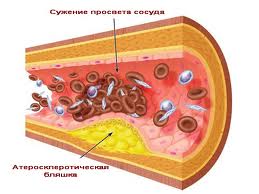 Атеросклероз не страшен?