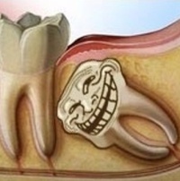 Как остановить рост зубов мудрости