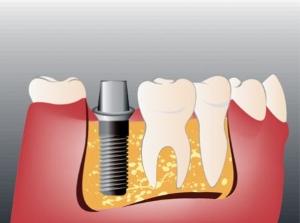 Осложнения после имплантации зубов