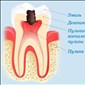 Воспалительные процессы, причины и виды пульпита
