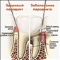 Пародонтит и пародонтоз